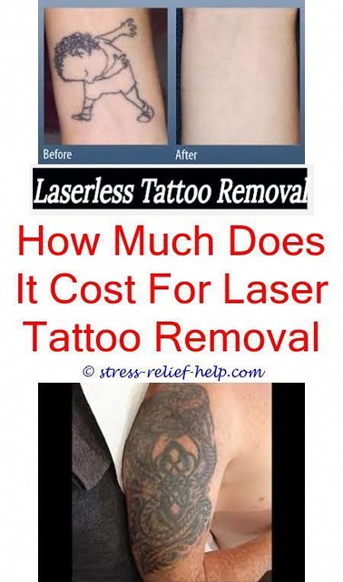 The Picosure Machine: Revolutionizing Tattoo Removal